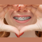 Getting braces is a big deal for teens! Here's five smart, helpful tips to get them ready, moms and dads!!